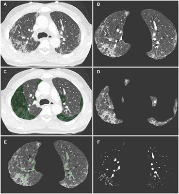 Impact of COVID-19 pneumonia on pulmonary vascular volume